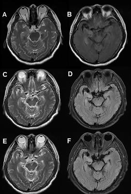 Case Report: Paroxysmal weakness of unilateral limb as an initial symptom in anti-LGI1 encephalitis: a report of five cases